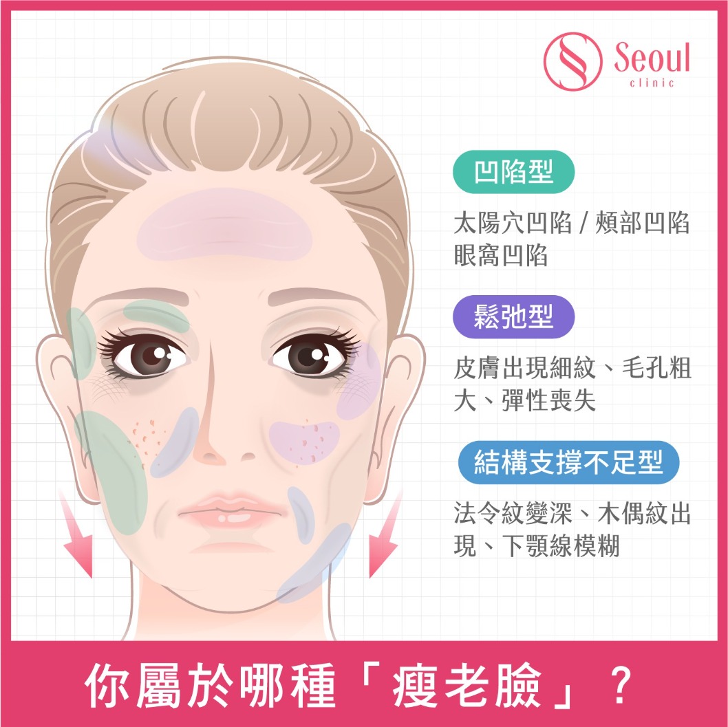 猛健樂臉-你是哪種「瘦老臉」？判斷猛健樂臉的 4 大徵兆-首爾醫美