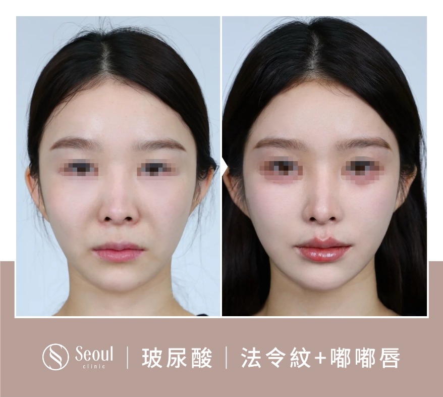 玻尿酸注射-玻尿酸淚溝案例BA3-首爾醫美診所