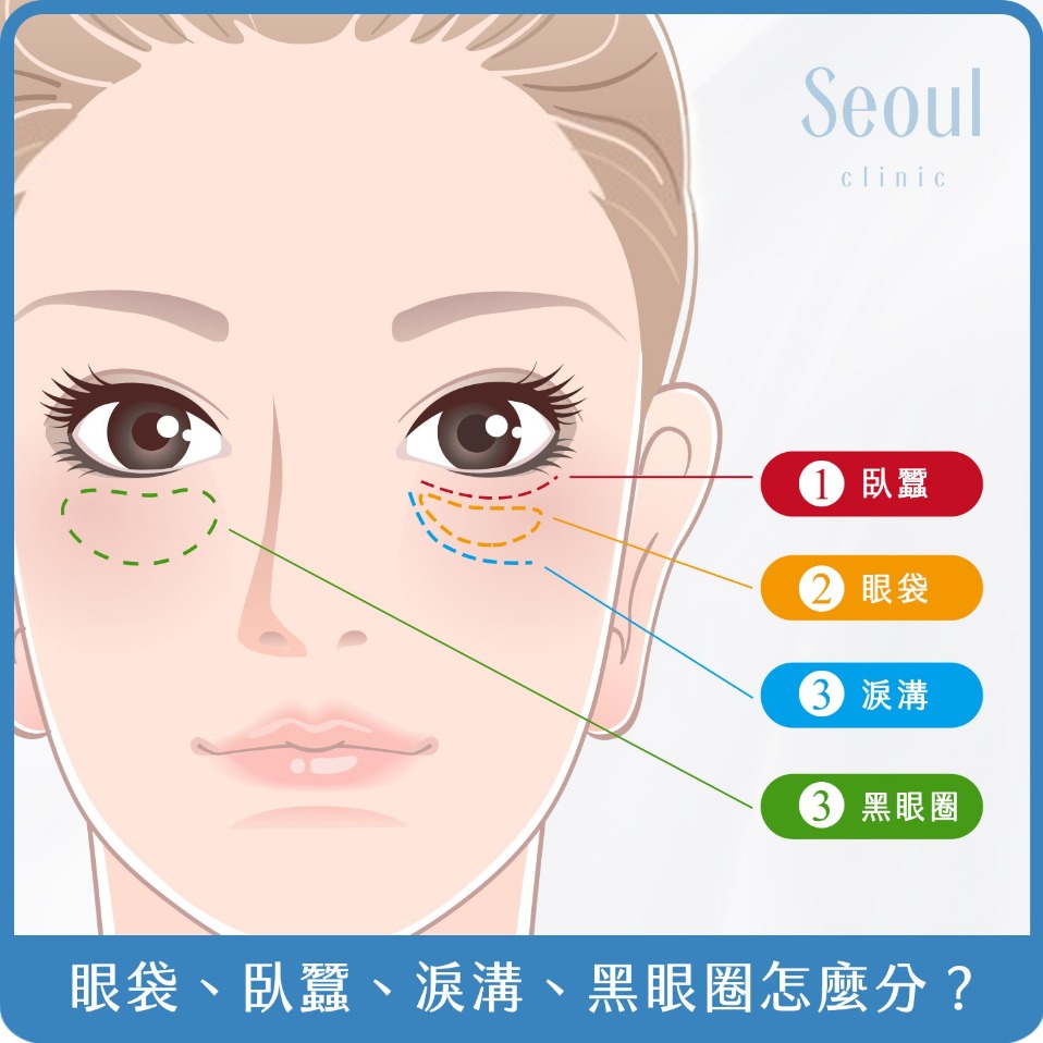眼袋-眼袋、淚溝、臥蠶怎麼分？-首爾醫美