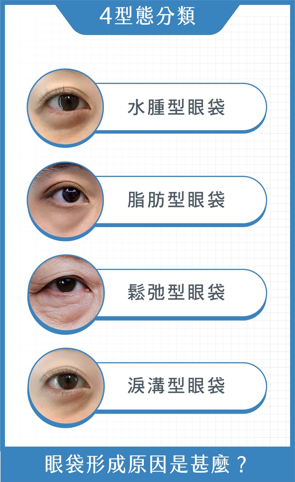 眼袋-眼袋成因?4種眼袋類型介紹-首爾醫美