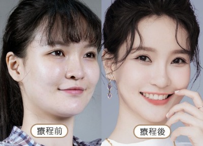 洢蓮絲_紋路撫平_首爾醫美