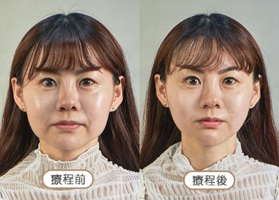 洢蓮絲_凹陷填補_首爾醫美