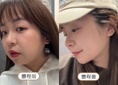 洢蓮絲_全臉緊緻_首爾醫美
