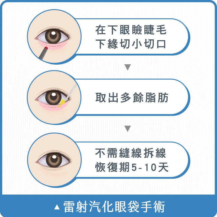 眼袋_汽化雷射眼袋手術_首爾醫美診所