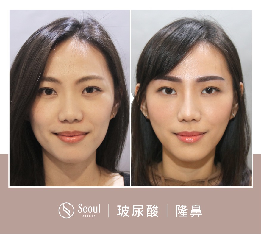 20250710_醫美seo用ba版型_玻尿酸_工作區域-1-複本-48