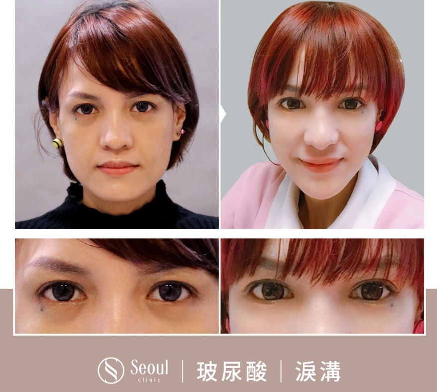 20250710_醫美seo用ba版型_玻尿酸_工作區域-1-複本-47