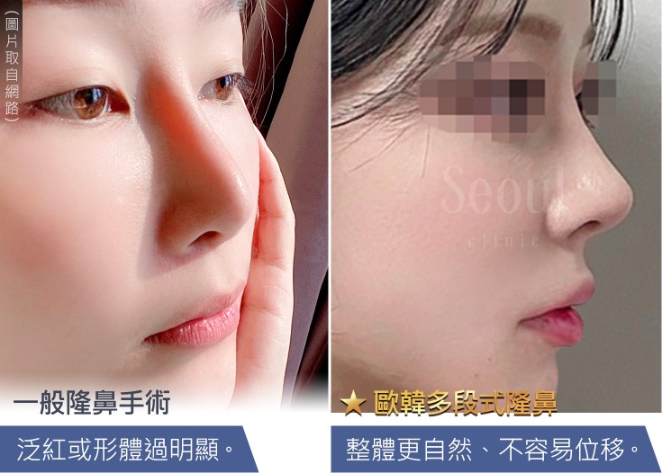 首爾醫美隆鼻手術_隆鼻示意圖