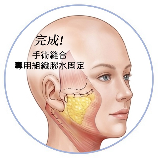 喬雅露_適應對象欲填補凹陷者_首爾醫美