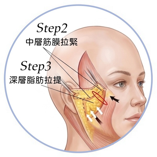喬雅露_適應對象欲局部精雕者_首爾醫美