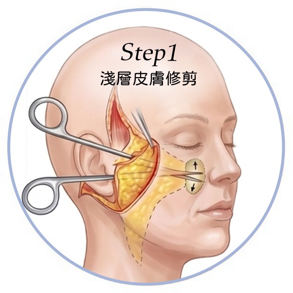 喬雅露_適應對象欲改善輪廓者_首爾醫美