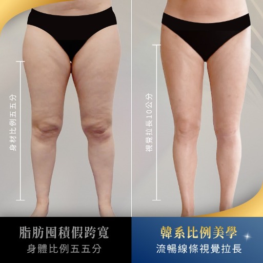 首爾醫美隆鼻手術_隆鼻示意圖
