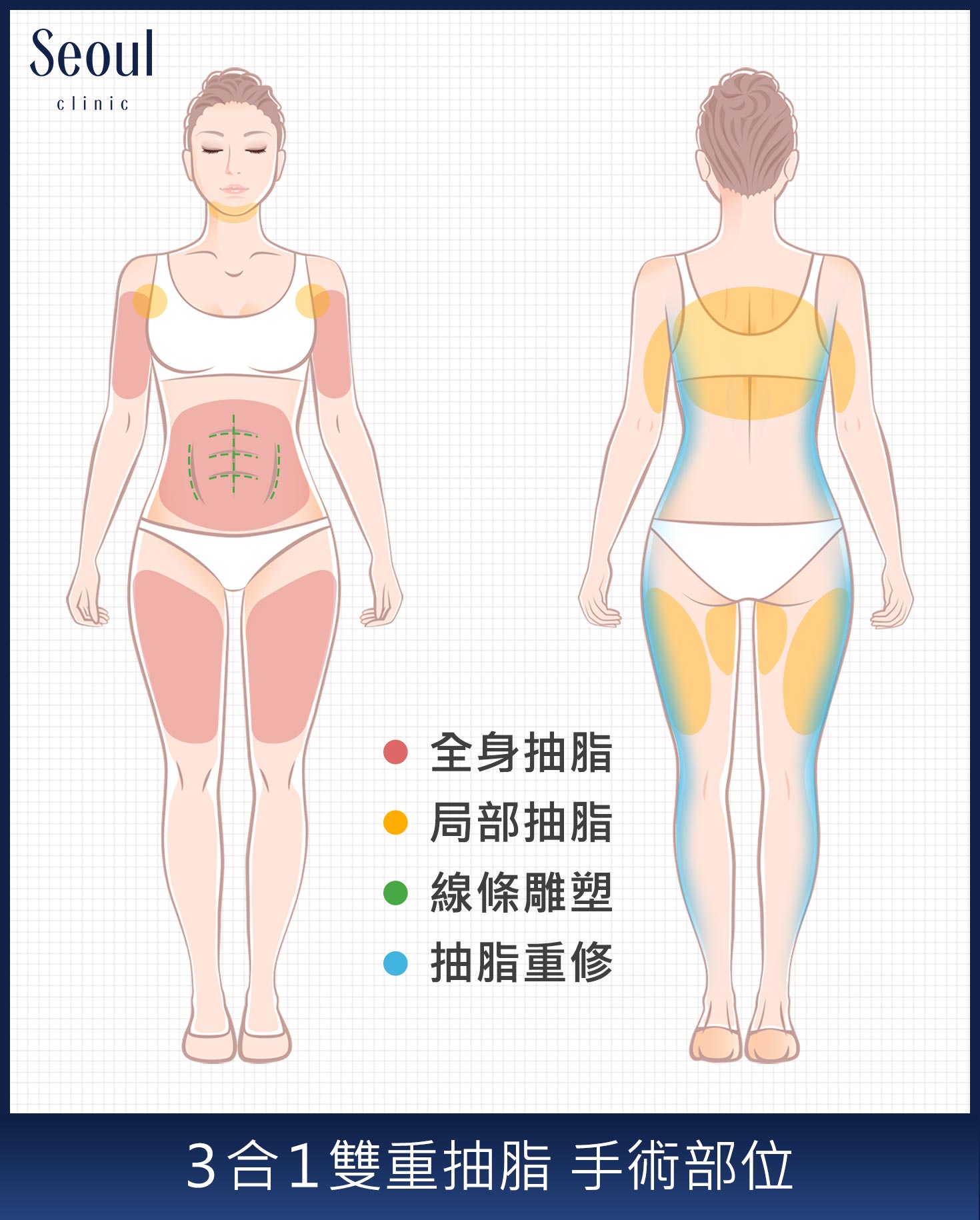 誰適合做「３合１雙重抽脂」手術