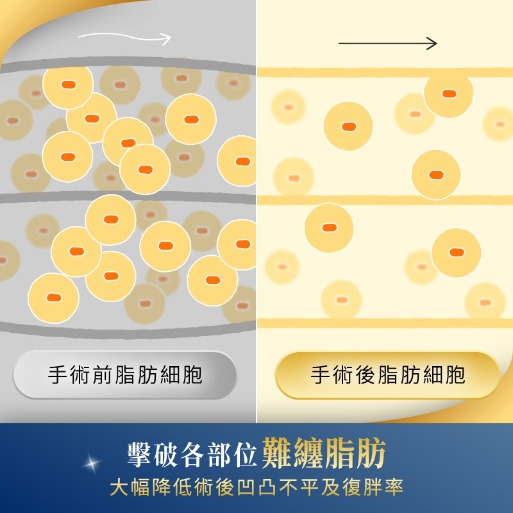 首爾醫美隆鼻手術_客製化隆鼻