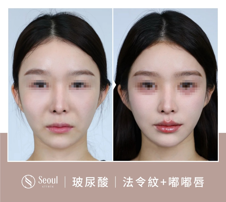 20250710_醫美seo用ba版型_玻尿酸_工作區域-1-複本-48
