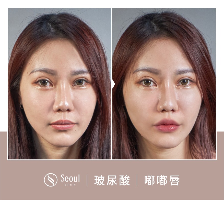 20250710_醫美seo用ba版型_玻尿酸_工作區域-1-複本-53