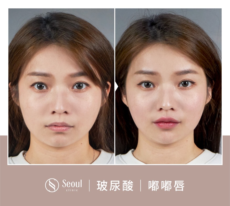 20250710_醫美seo用ba版型_玻尿酸_工作區域-1-複本-52