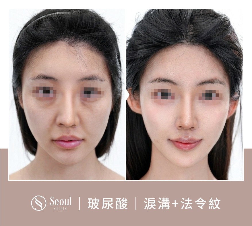 20250710_醫美seo用ba版型_玻尿酸_工作區域-1-複本-47