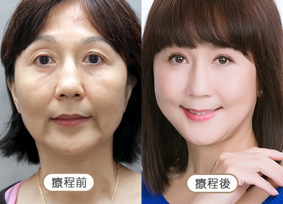 20250710_醫美seo用ba版型_玻尿酸_工作區域-1-複本-53