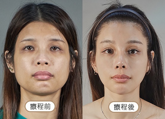 20250710_醫美seo用ba版型_玻尿酸_工作區域-1-複本-53
