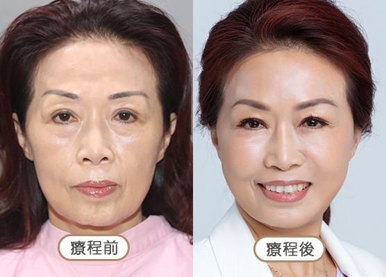 20250710_醫美seo用ba版型_玻尿酸_工作區域-1-複本-52