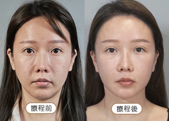 20250710_醫美seo用ba版型_玻尿酸_工作區域-1-複本-52