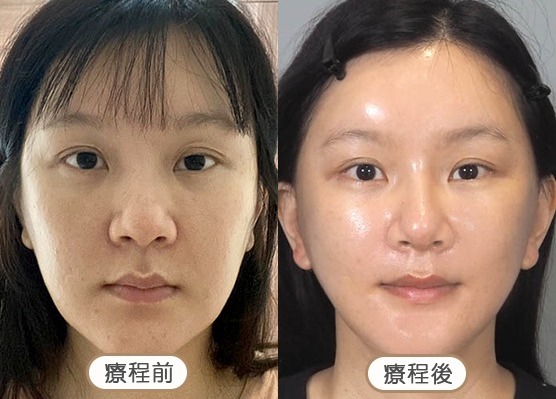 20250710_醫美seo用ba版型_玻尿酸_工作區域-1-複本-52