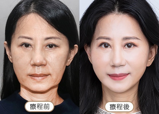20250710_醫美seo用ba版型_玻尿酸_工作區域-1-複本-53