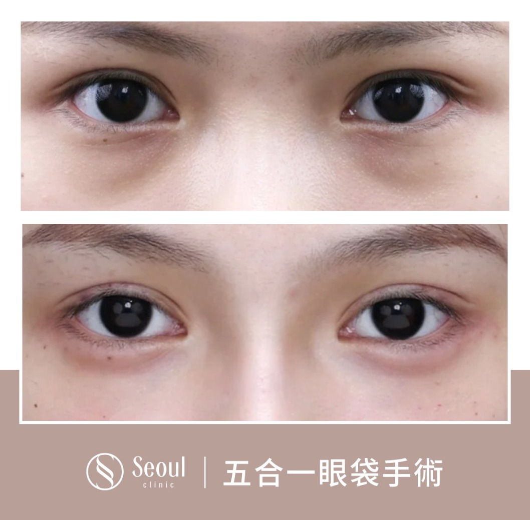 基礎雙眼皮-雙眼皮手術案例3-首爾醫美診所