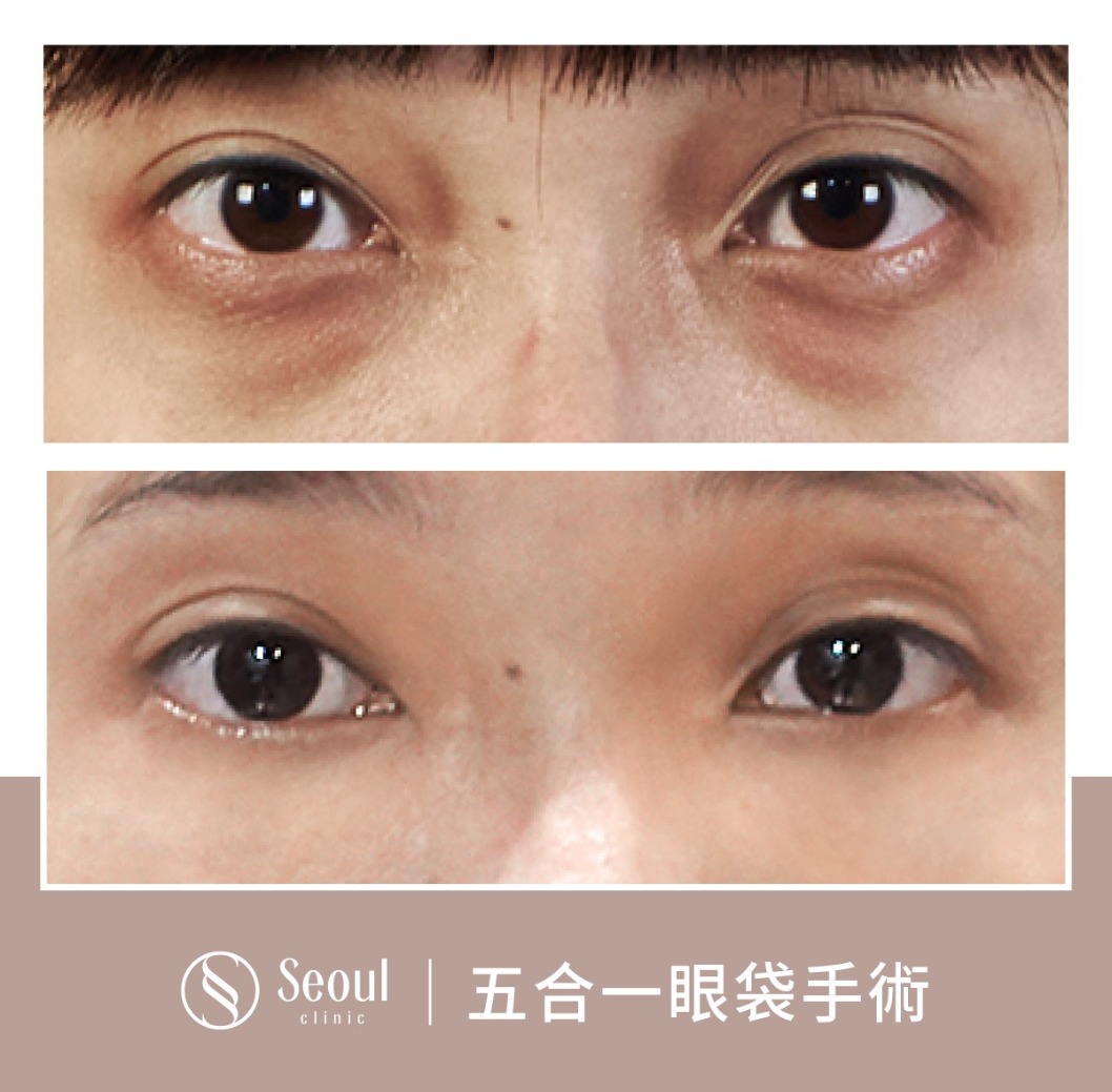 脂肪型雙眼皮-雙眼皮手術案例2-首爾醫美診所