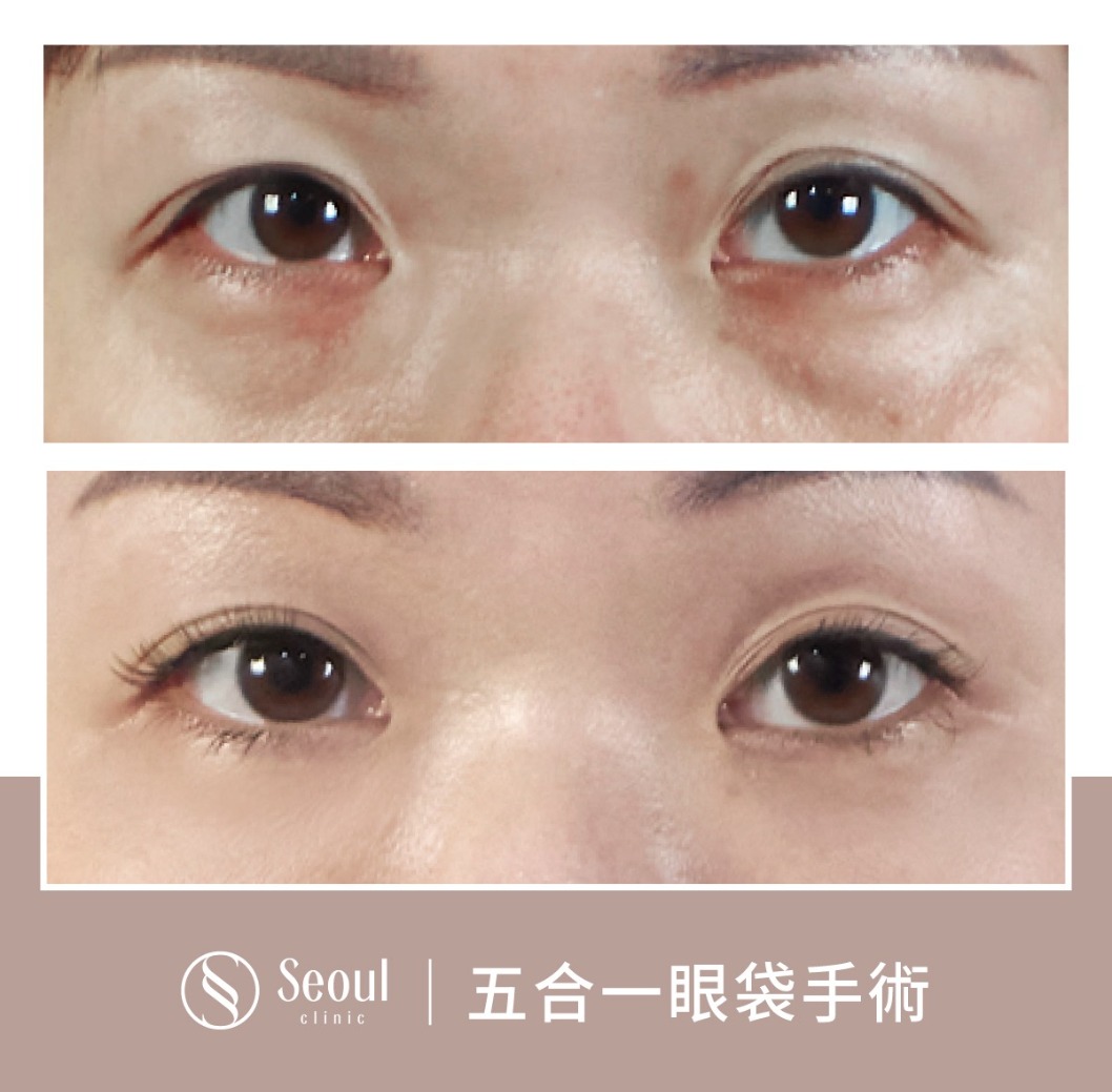 不對稱雙眼皮-雙眼皮手術案例1-首爾醫美診所