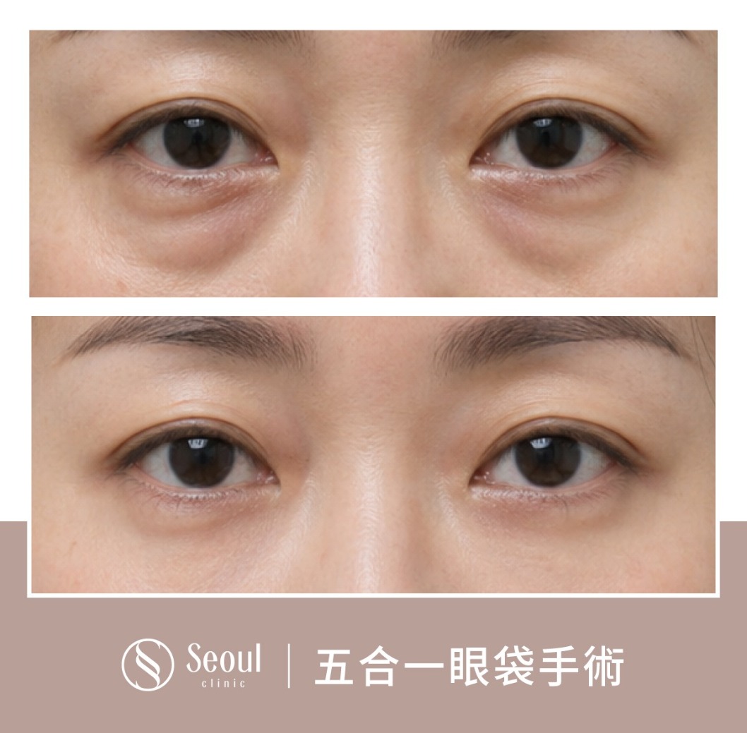 特殊構造型雙眼皮-雙眼皮手術案例1-首爾醫美診所