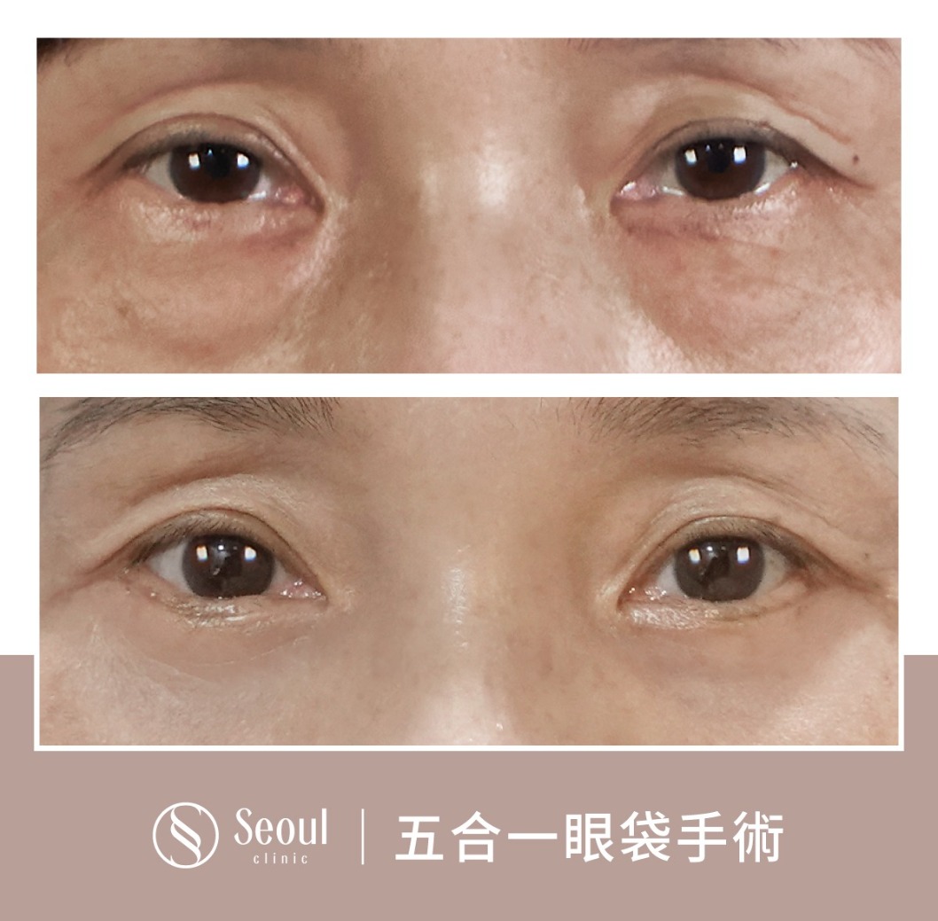 鬆弛型雙眼皮-雙眼皮手術案例1-首爾醫美診所