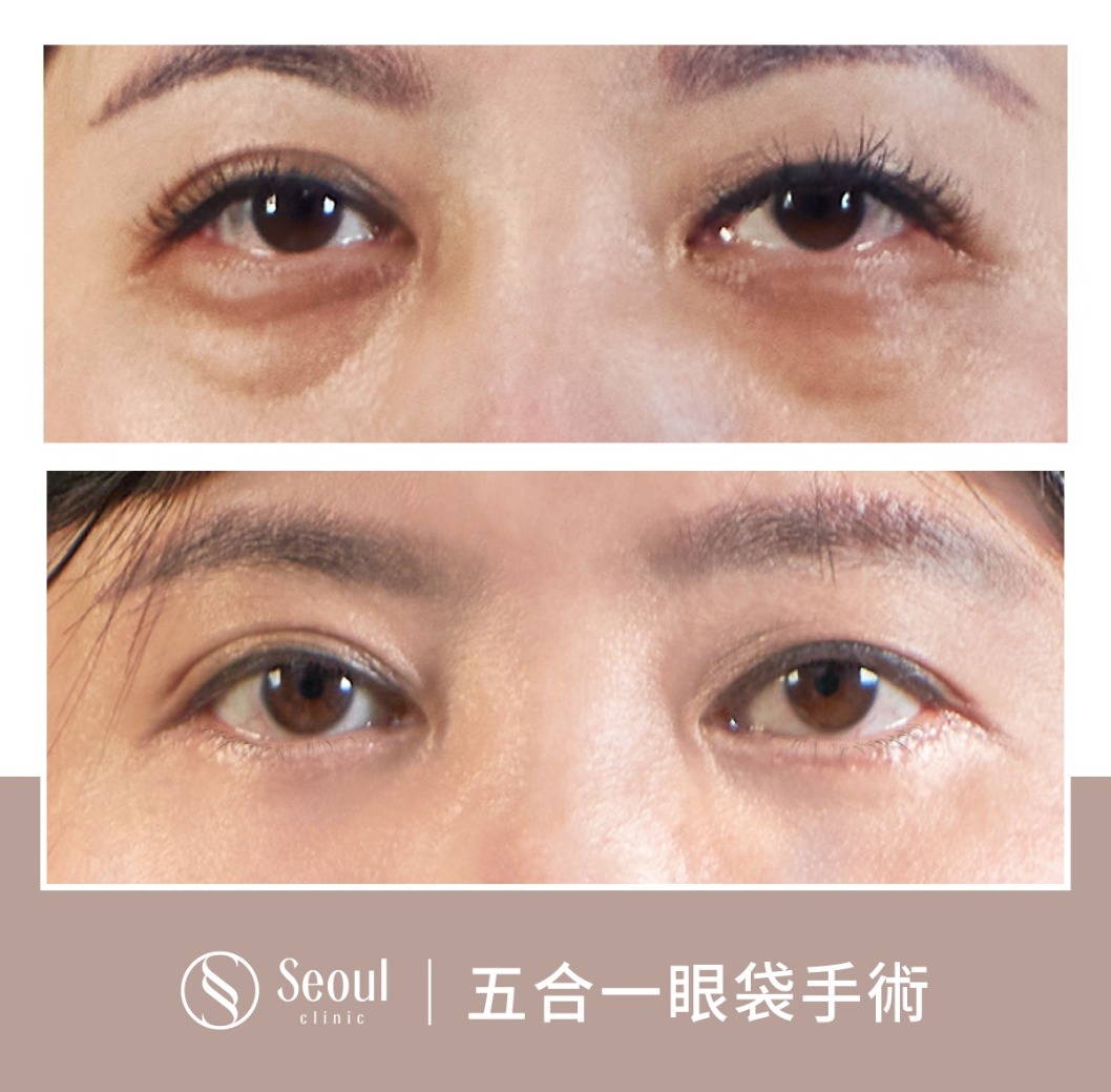 不對稱雙眼皮-雙眼皮手術案例2-首爾醫美診所
