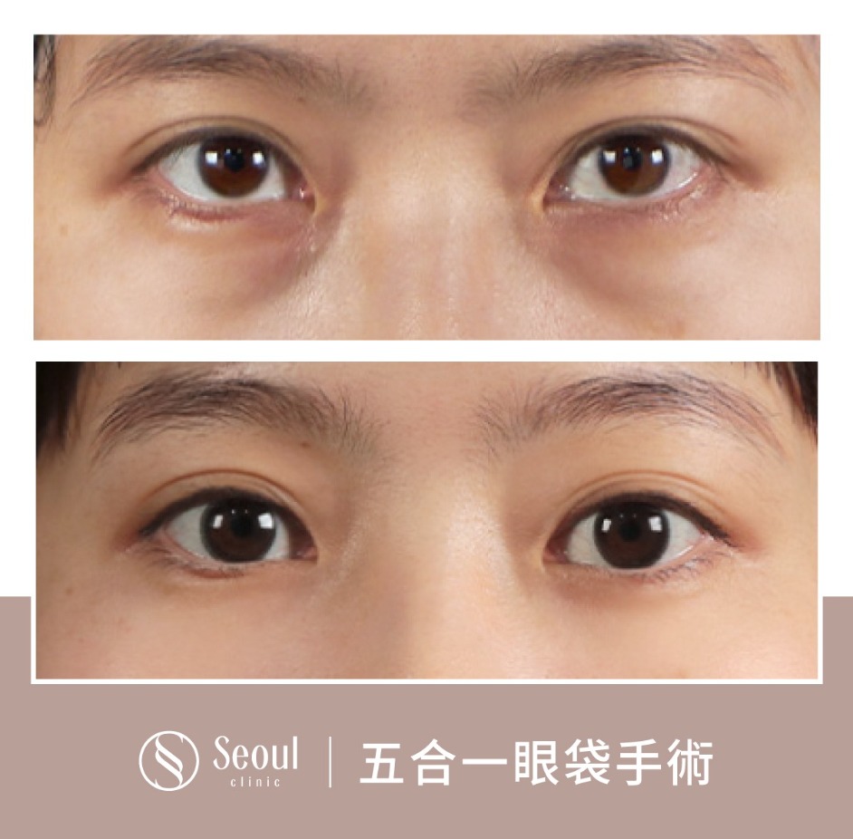 基礎雙眼皮-雙眼皮手術案例3-首爾醫美診所
