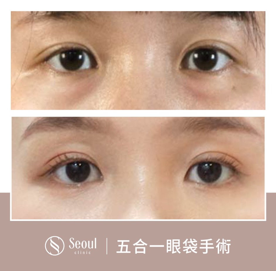 基礎雙眼皮-雙眼皮手術案例2-首爾醫美診所