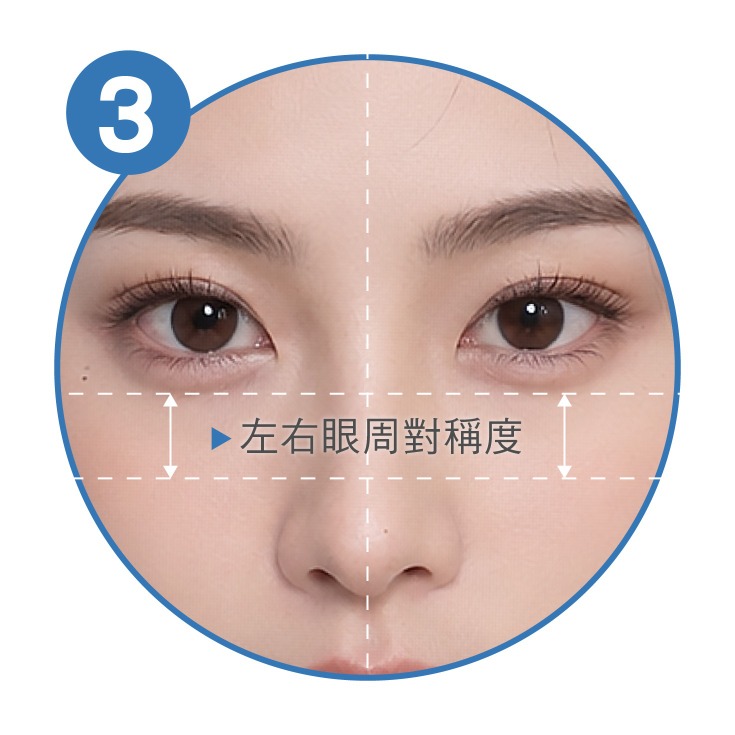 眼袋手術_左右眼周對稱度_首爾醫美