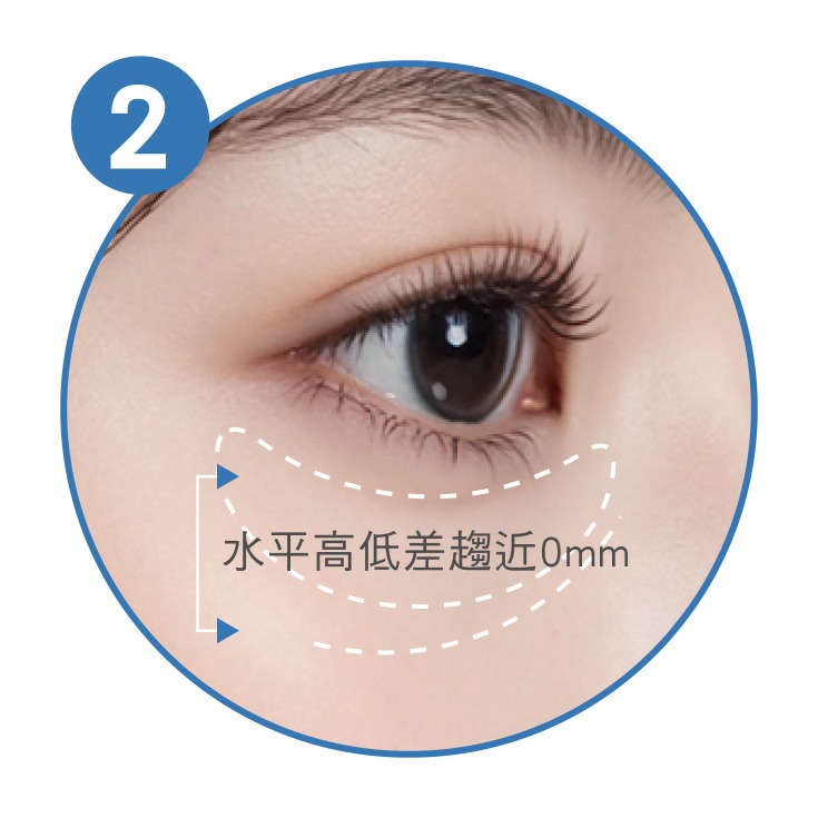 眼袋手術_眼袋淚溝高低差趨近 0 mm_首爾醫美