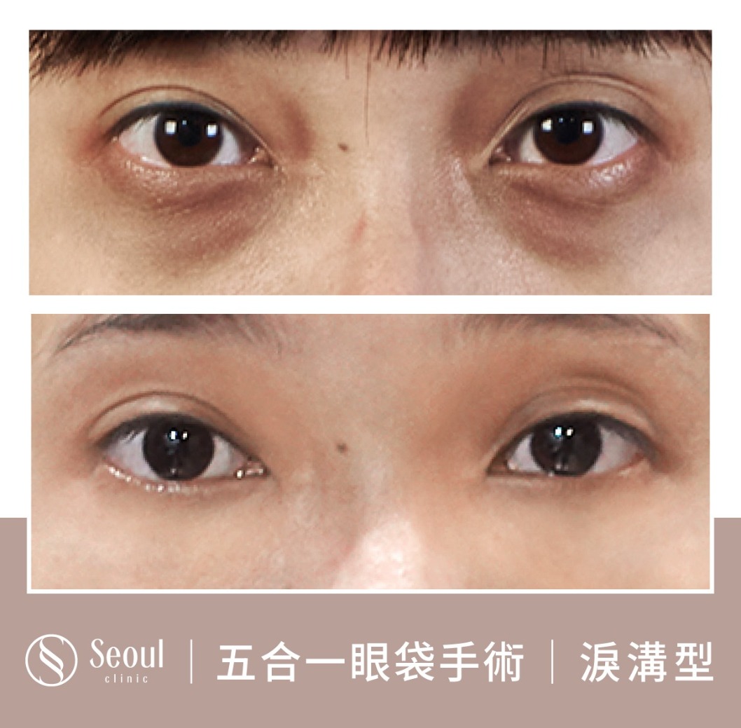 淚溝型眼袋-眼袋手術案例2-首爾醫美診所
