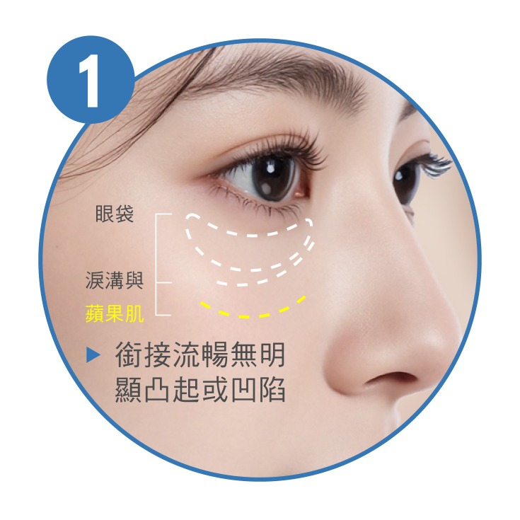 眼袋手術_自然眼下弧度_首爾醫美