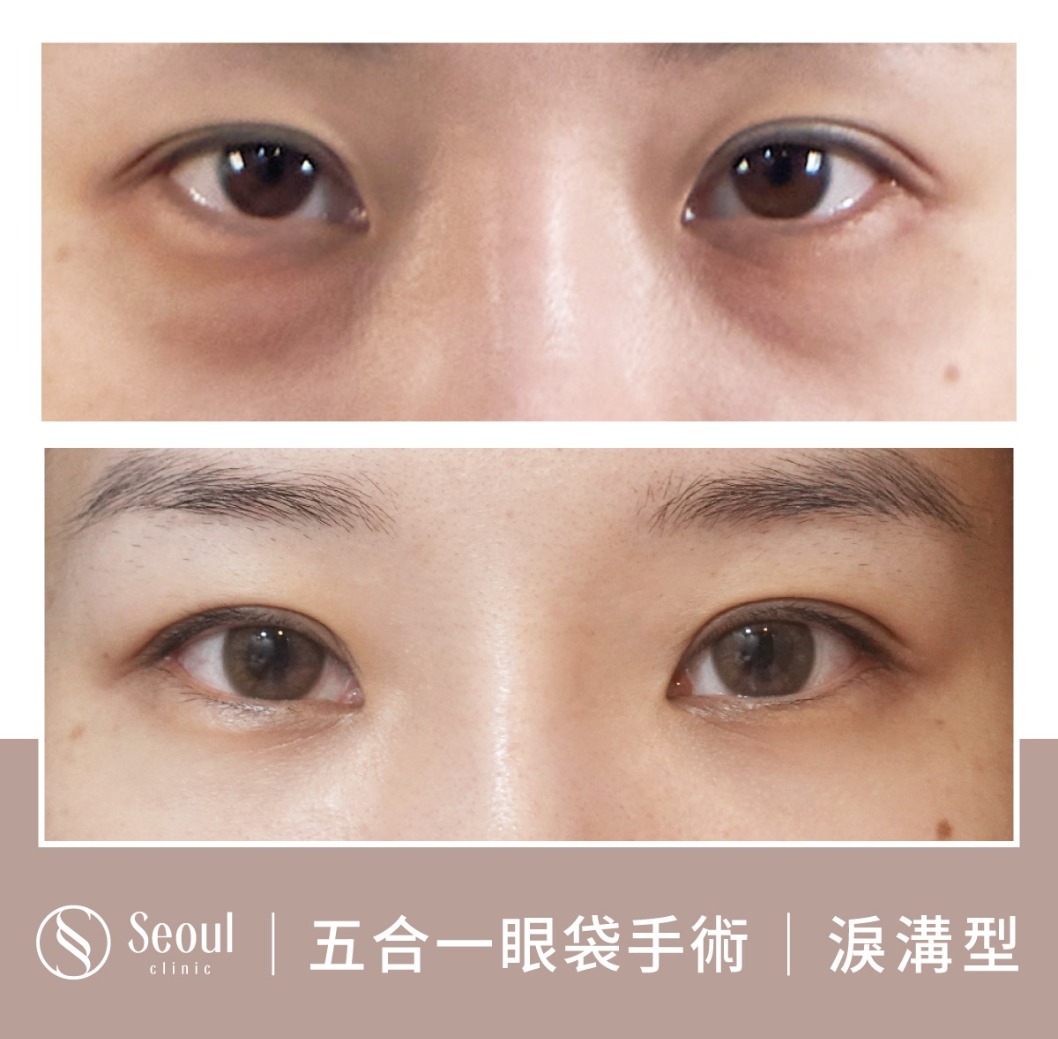 淚溝型眼袋-眼袋手術案例3-首爾醫美診所