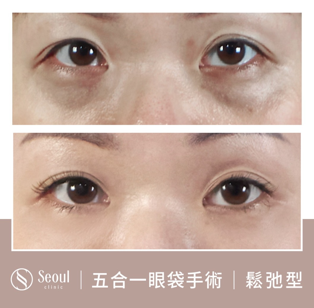 鬆弛型眼袋-眼袋手術案例1-首爾醫美診所