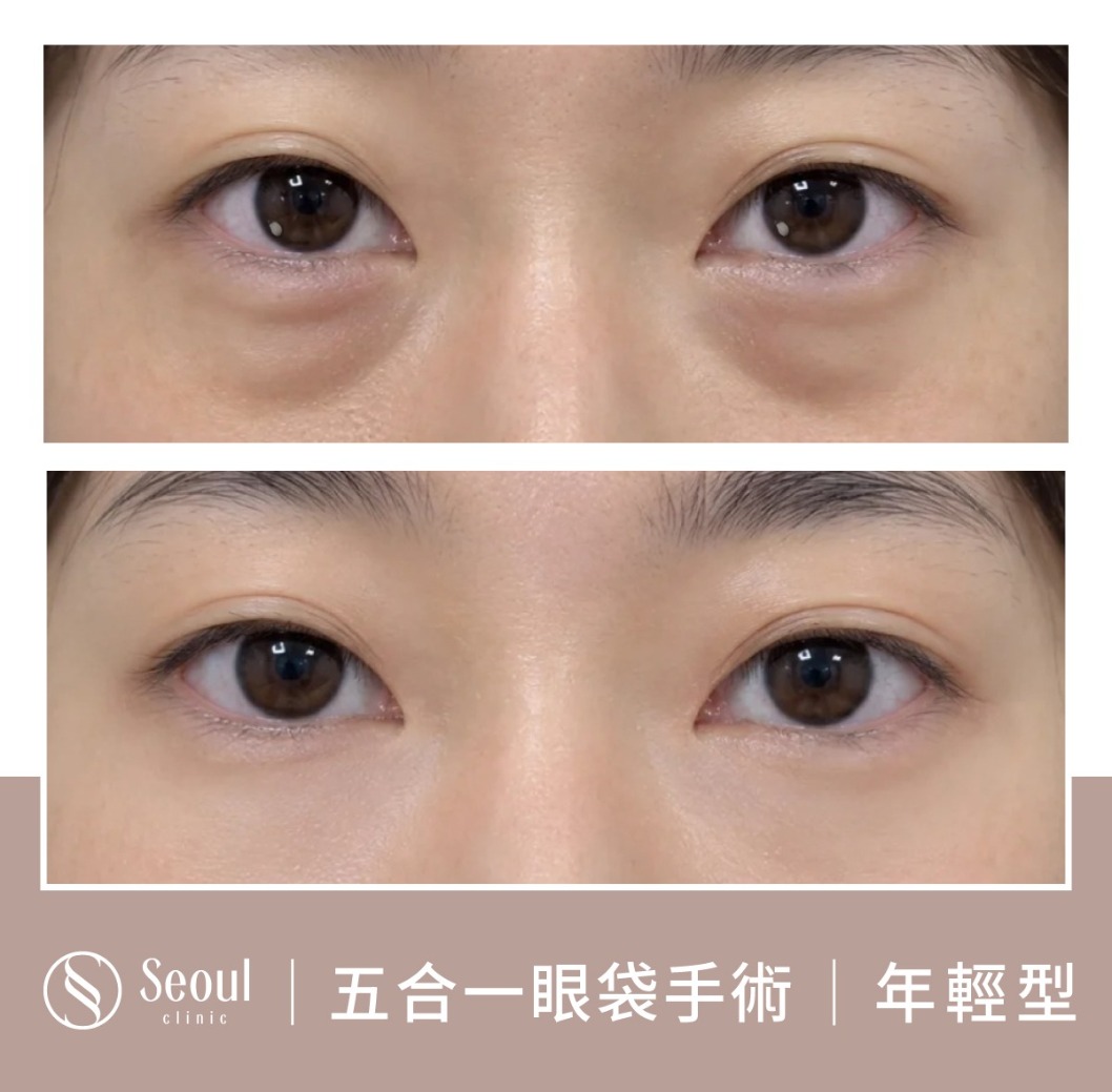 年輕型眼袋-眼袋手術案例1-首爾醫美診所