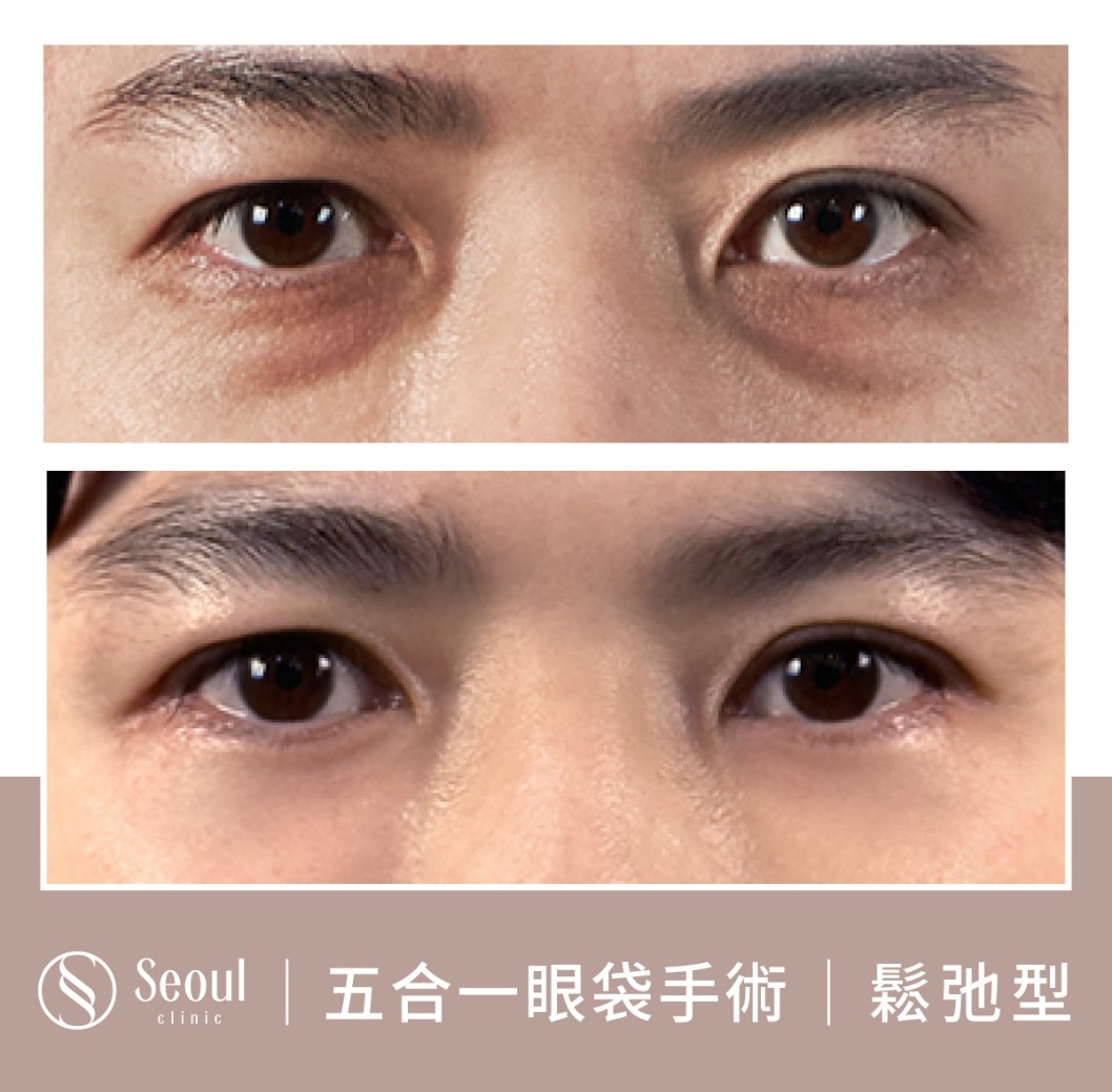 鬆弛型眼袋-眼袋手術案例3-首爾醫美診所