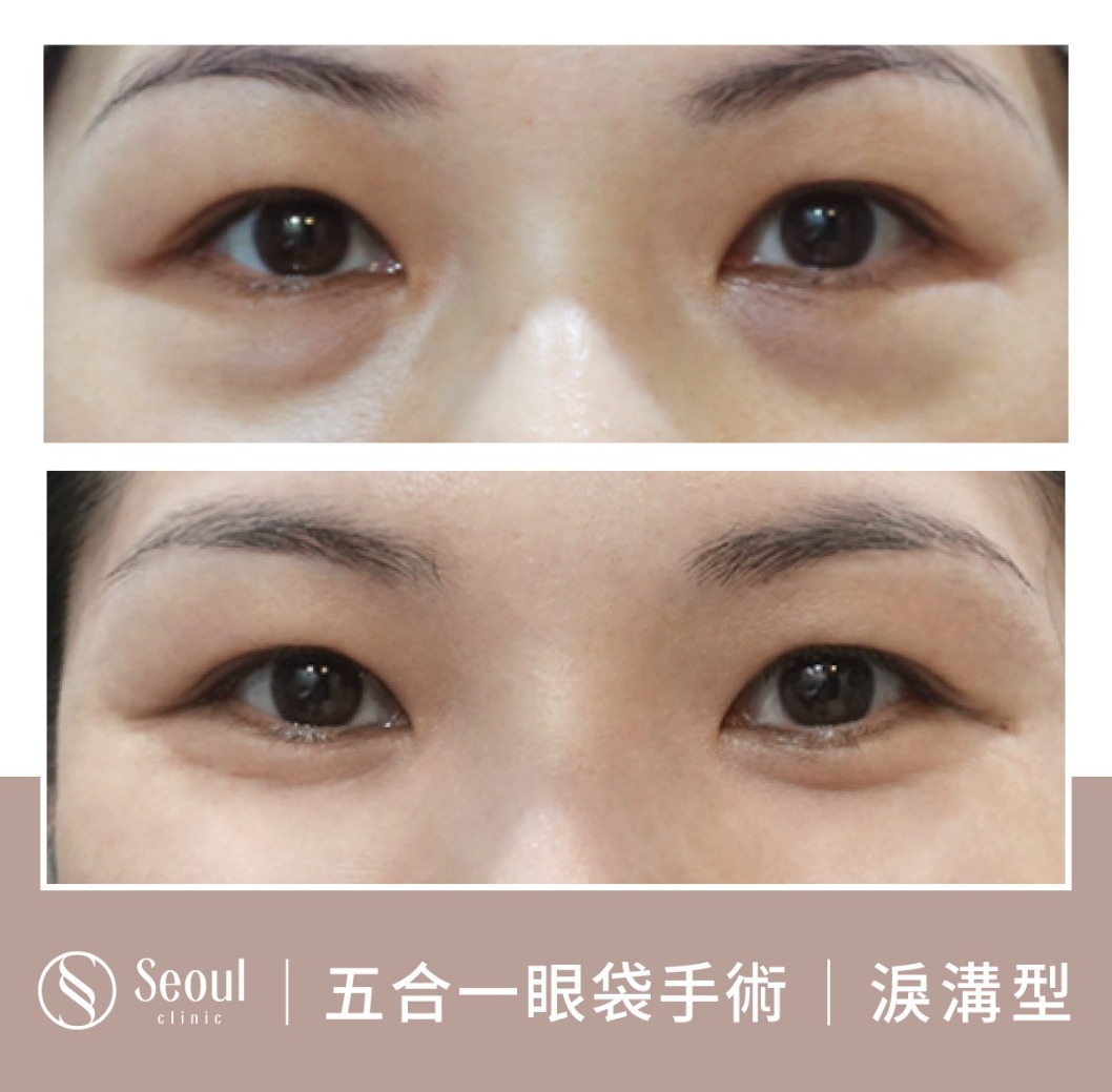 淚溝型眼袋-眼袋手術案例4-首爾醫美診所