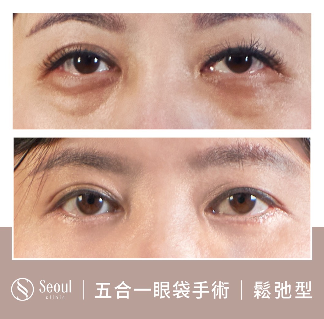 鬆弛型眼袋-眼袋手術案例2-首爾醫美診所
