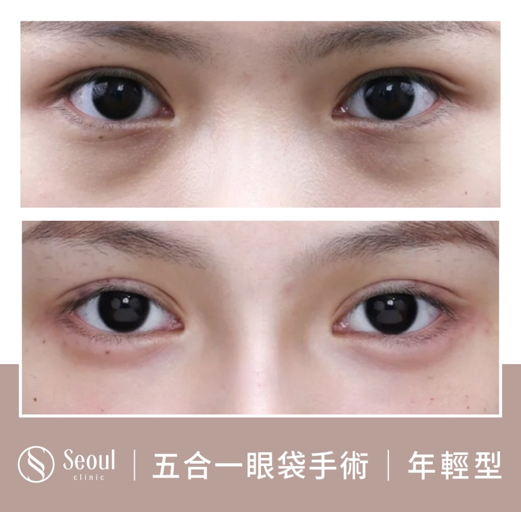 年輕型眼袋-眼袋手術案例3-首爾醫美診所