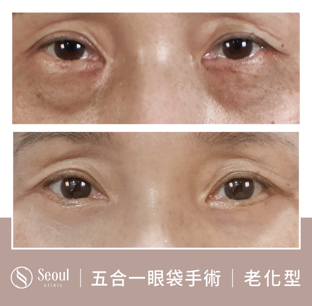 老化型眼袋-眼袋手術案例1-首爾醫美診所