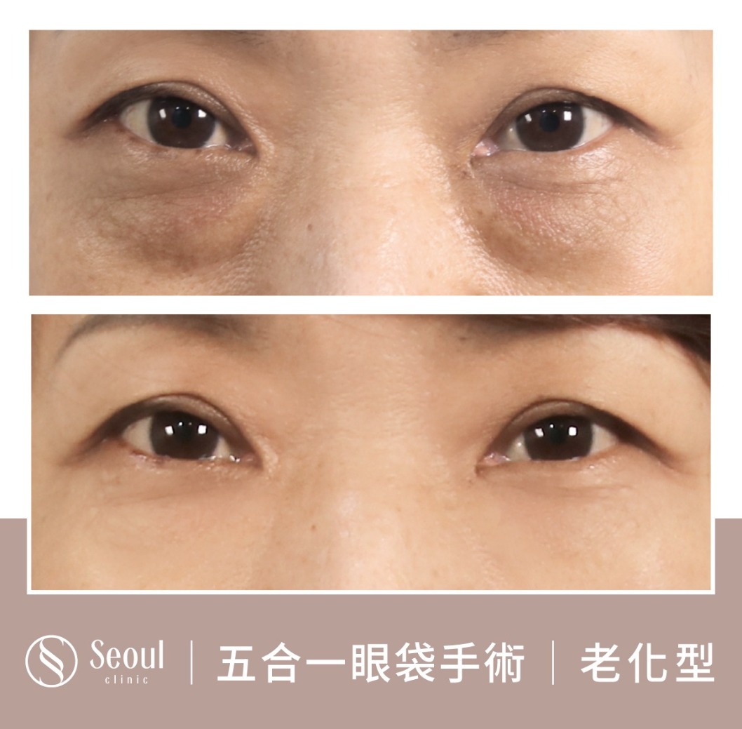 老化型眼袋-眼袋手術案例2-首爾醫美診所