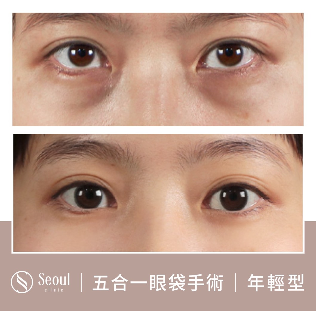 年輕型眼袋-眼袋手術案例2-首爾醫美診所